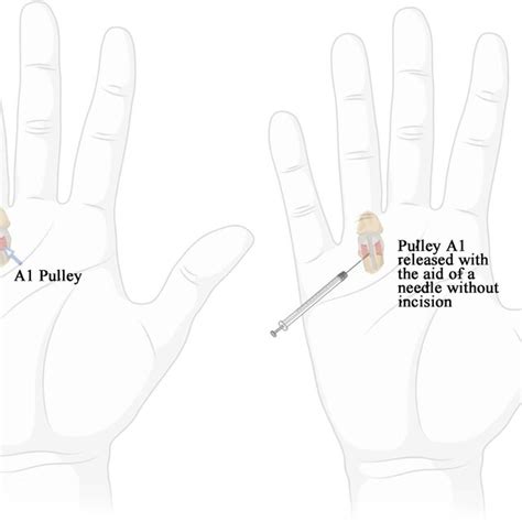 Image A With An Open Surgical Approach To Release The A1 Pulley By