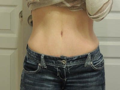 When i recreate a belly button during a tummy tuck, i take into consideration the vectors and the forces that counteract the pull of the abdominal flap, which can create a belly button that looks like a slit, elongated and unnatural. This CANNOT Be My Belly Button!!!! It Has Got to Go ...