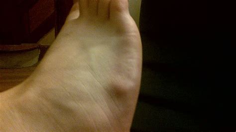Ganglion Cyst Foot Causes Symptoms Pictures Diagnoses Treatment