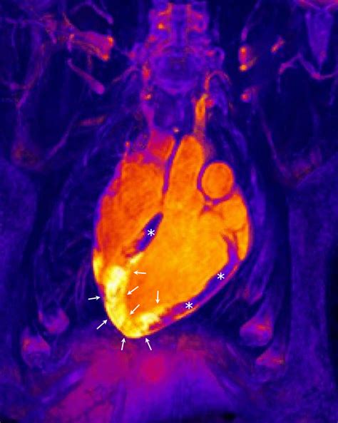 Dramatic New Studies Into Inflammation In The Infarcted Heart Could