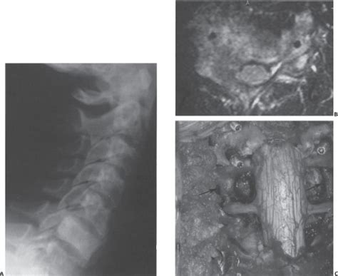 Primary Osseous Tumors Of The Cervical Spine Neupsy Key
