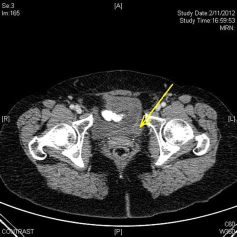 Abdominal Ct Scan With Contrast Yellow Arrow Showing A 16 Mm Tumor In