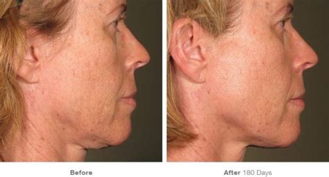 Ultherapy Lower Face And Jowls Treatments Smooth Synergy Medical Spa And Laser Center