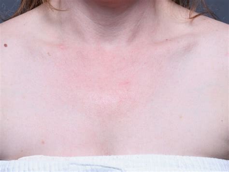 Dminished Redness On Chest After 2 Excel V Global Treatments