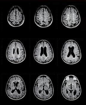 Sign up for more information. Multiple sclerosis: raising awareness of a complex disease ...