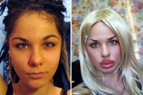 Woman Gets 100 Silicone Injections To Have The Worlds Biggest Lips