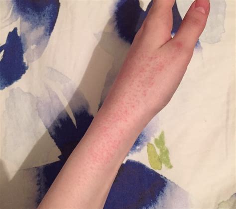 Surviving Acne Rash On Hands