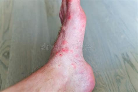 Bed Bug Bites On A Foot Stock Photo Image Of Insect 27214516