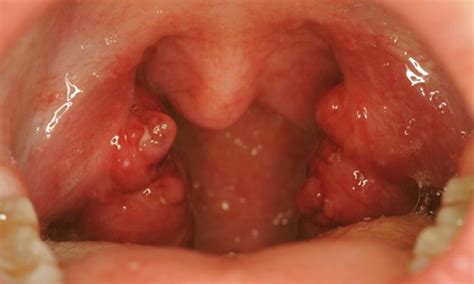 👉 Enlarged Tonsils Pictures Symptoms Causes Treatment January 2022