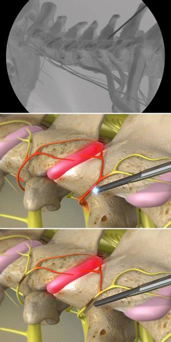 Cervical Facet Radiofrequency Neurotomy Pain Specialists Of Southern