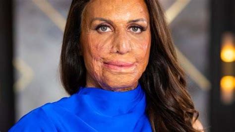 Uncut Turia Pitt Opens Up On That Rivalry With Ronnie Hit Network