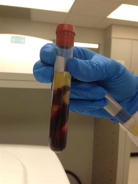After Centrifuging A Patients Blood The Red Blood Cells Separated