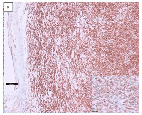 Spindle Cell Tumor On The Deep Soft Tissue Of The Back With Myxoid