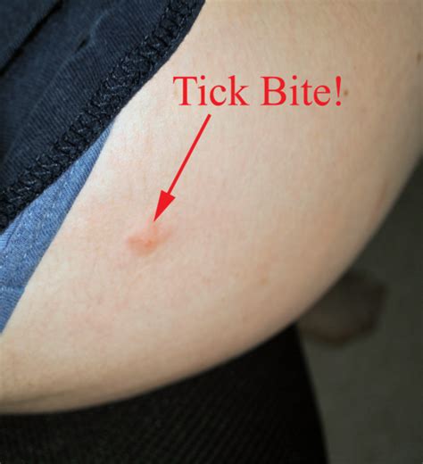 These microbes cause diseases which can be severely debilitating or fatal to domestic animals. tick bite on Tumblr