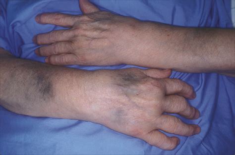 Blue Black Pigmentation Of Legs And Arms In A 68 Year Old Woman—quiz