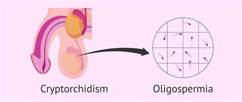 Cryptorchidism And Oligospermia