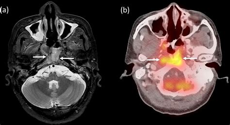 Essential Imaging Of The Nasopharyngeal Space With Special Focus On