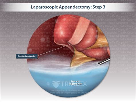 Laparoscopic Appendectomy Step 3 Trial Exhibits Inc