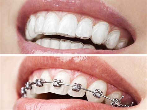 Orthodontics Metal Braces Invisalign Invisalign Orthodontics Metal Braces
