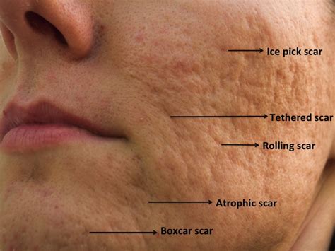 Acne Scar Treatment Cincinnati Acne Scar Lasers