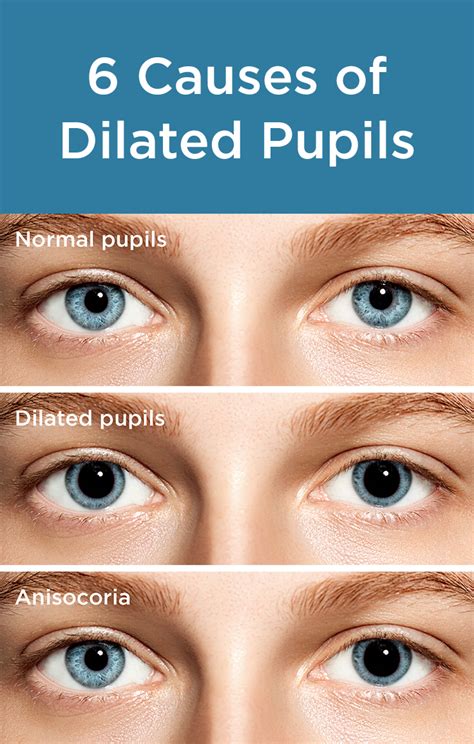 Dilated Pupils Causes Concerns And Treatment All Abou