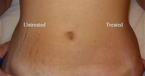 How long should it take for scarring to just go away on its own? Shamila Beauty Corner: Home Remedies & Ayurvedic Herbs to ...