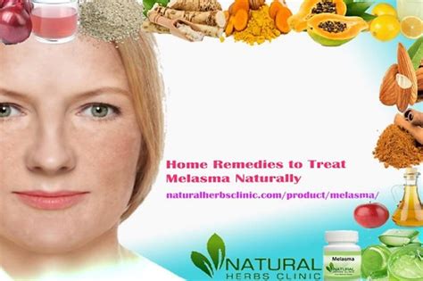 Natural Herbs Clinic Home Remedies For Melasma Lookbook