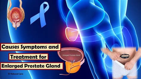 Causes Symptoms And Treatment For Enlarged Prostate Gland YouTube