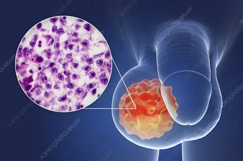 Testicular Cancer Illustration And Light Micrograph Stock Image F Science Photo