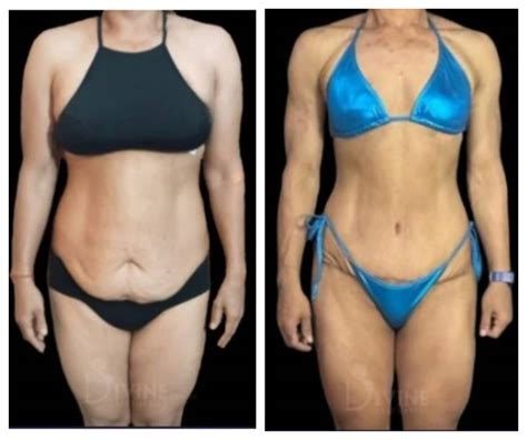 Tummy Tuck Before And After Tummy Tuck Surgery Result