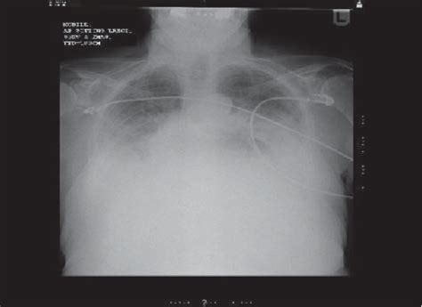 Chest X Ray Taken On Presentation To The Emergency Department There Is