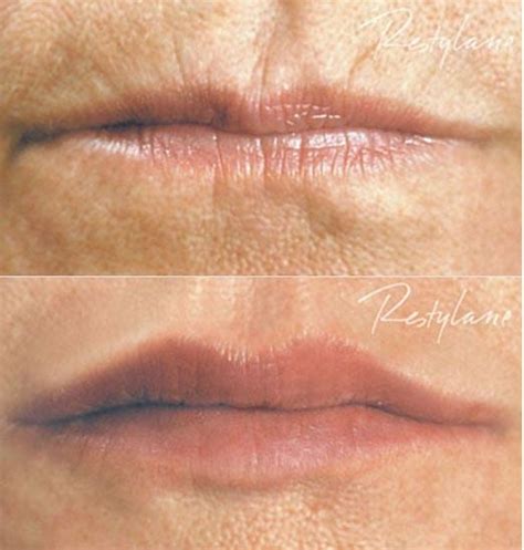 Lip Lines Lip Filler Treatment Skinviva Manchester