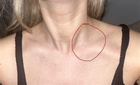 Lump On Neck Is This Normal Or Not Picture Mumsnet