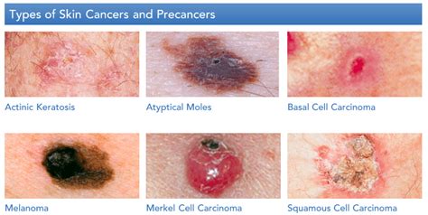 How To See If You Have Skin Cancer What Are The Symptoms Of Skin
