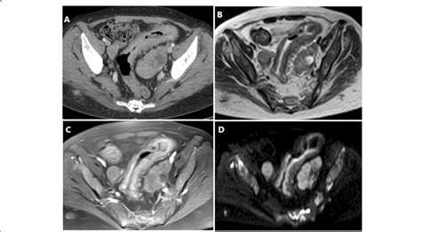 A Axial Post Contrast Ct Pelvis B Axial T2 Weighted Image And C