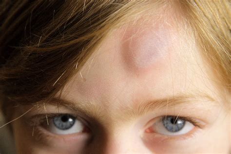Forehead Bruise Daniel Paquet Flickr