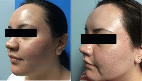 Acne Scar Removal Los Angeles Acne Scar Treatment Dr Behnam 2022