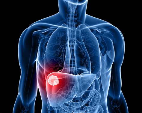 What Are The Stages Of Liver Cancer Fatty Liver Disease