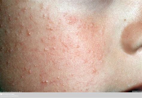 A Dermatologists Tips For Managing Keratosis Pilaris Kp Skincare
