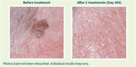 Eskata Treatment Philadelphia L Best Dark Spot Treatment Pa