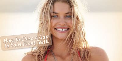You can minimize the swelling and bleeding by holding a wet compress against the gap in your jaw or even against the outside of your face on the home remedies for chipped, cracked, broken, and dislodged teeth are not permanent solutions. Fix Teeth Gap in Just 30 Days | Alternative to braces ...