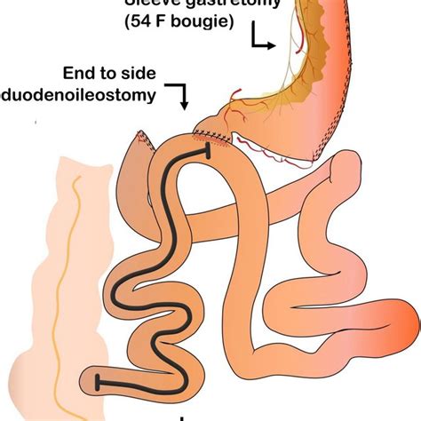 Single Anastomosis Duodeno Ileal Anastomosis With Sleeve Gastrectomy Download Scientific