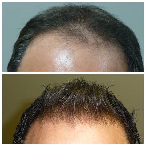 The Top Five Benefits Of A Hair Transplant Hair And Facial Plastics