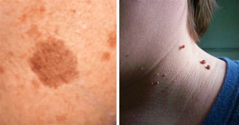 Heres How To Naturally Resolve Skin Tags Warts Blackheads Moles And