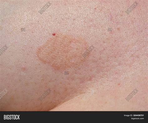 Fungal Skin Rash Image And Photo Free Trial Bigstock