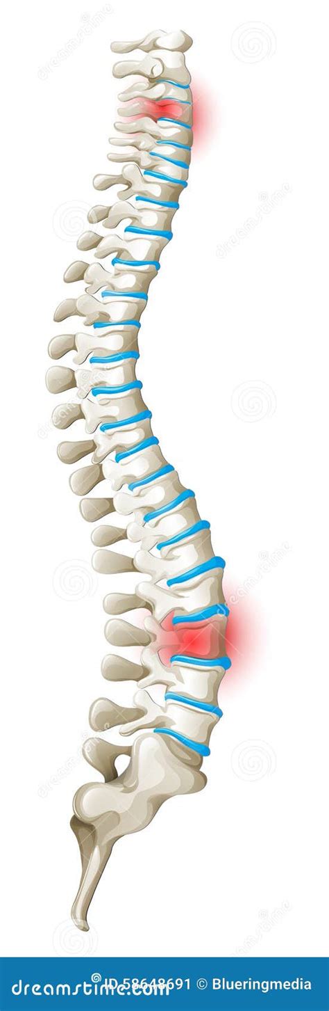 Back Muscles Diagram Pain