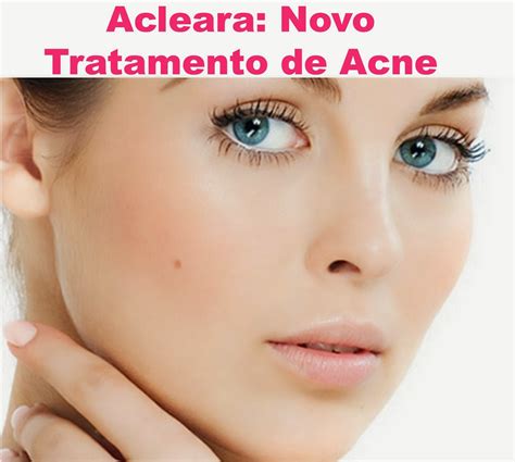 Acleara Novo Tratamento Para Acne Woman Chic