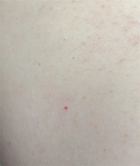 Petechiae Pinpoint Red Dots On Skin Wheelsopel