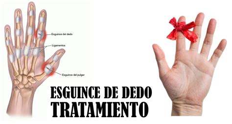 Esguince Del Dedo De La Mano Tratamiento Y Cómo Evitar El Dolor