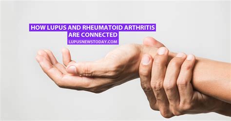 How Lupus And Rheumatoid Arthritis Are Connected Lupus News Today